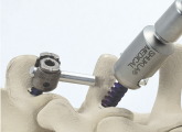 Medical Company Develops Surgical Prototypes with Metal X Printer
